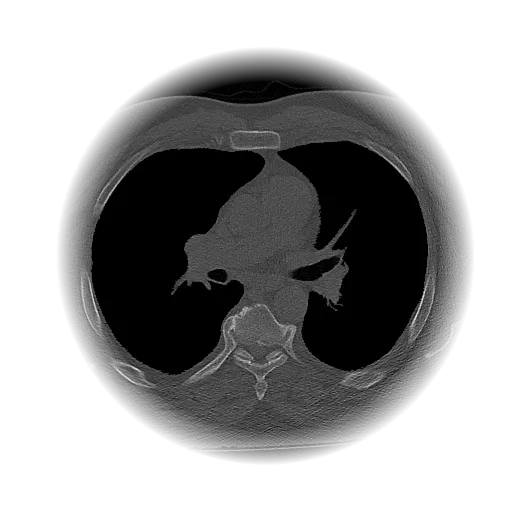 Blood Vessel Removal