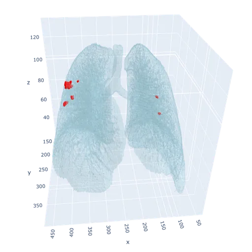 3D Lung Nodule Visualization